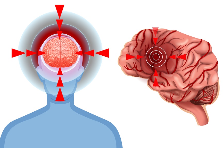 Migraine 4 phases, symptoms and treatments - GCC Business News